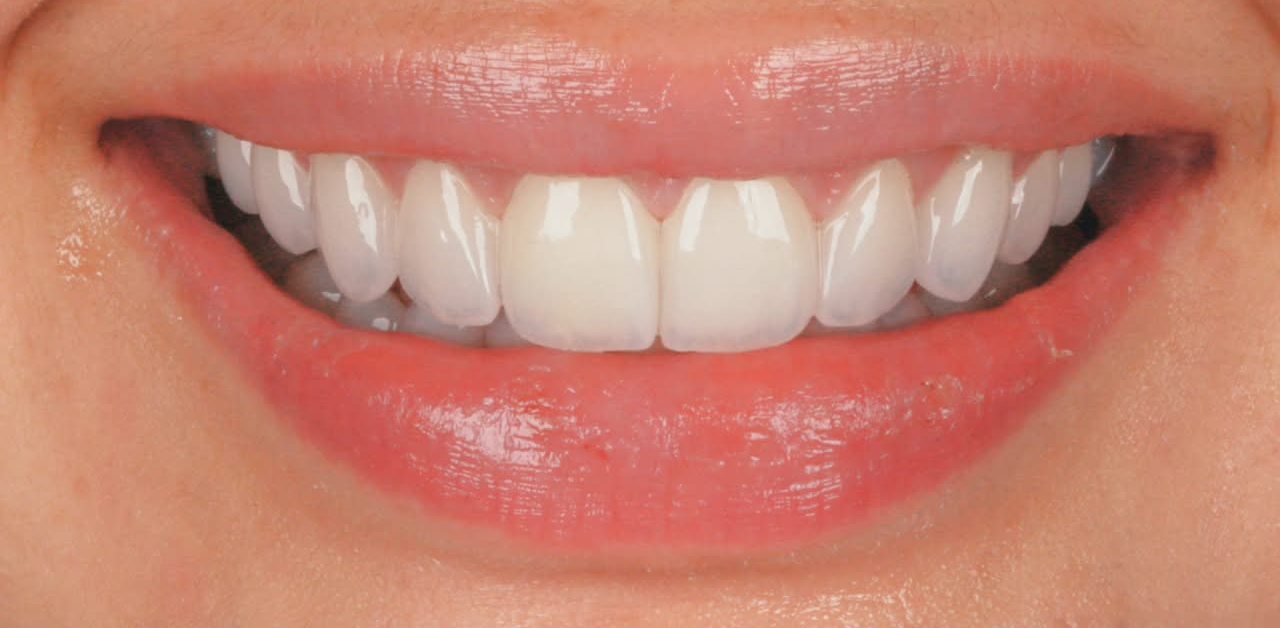 Sorriso natural reconstruído com lentes de porcelana na Villodonto