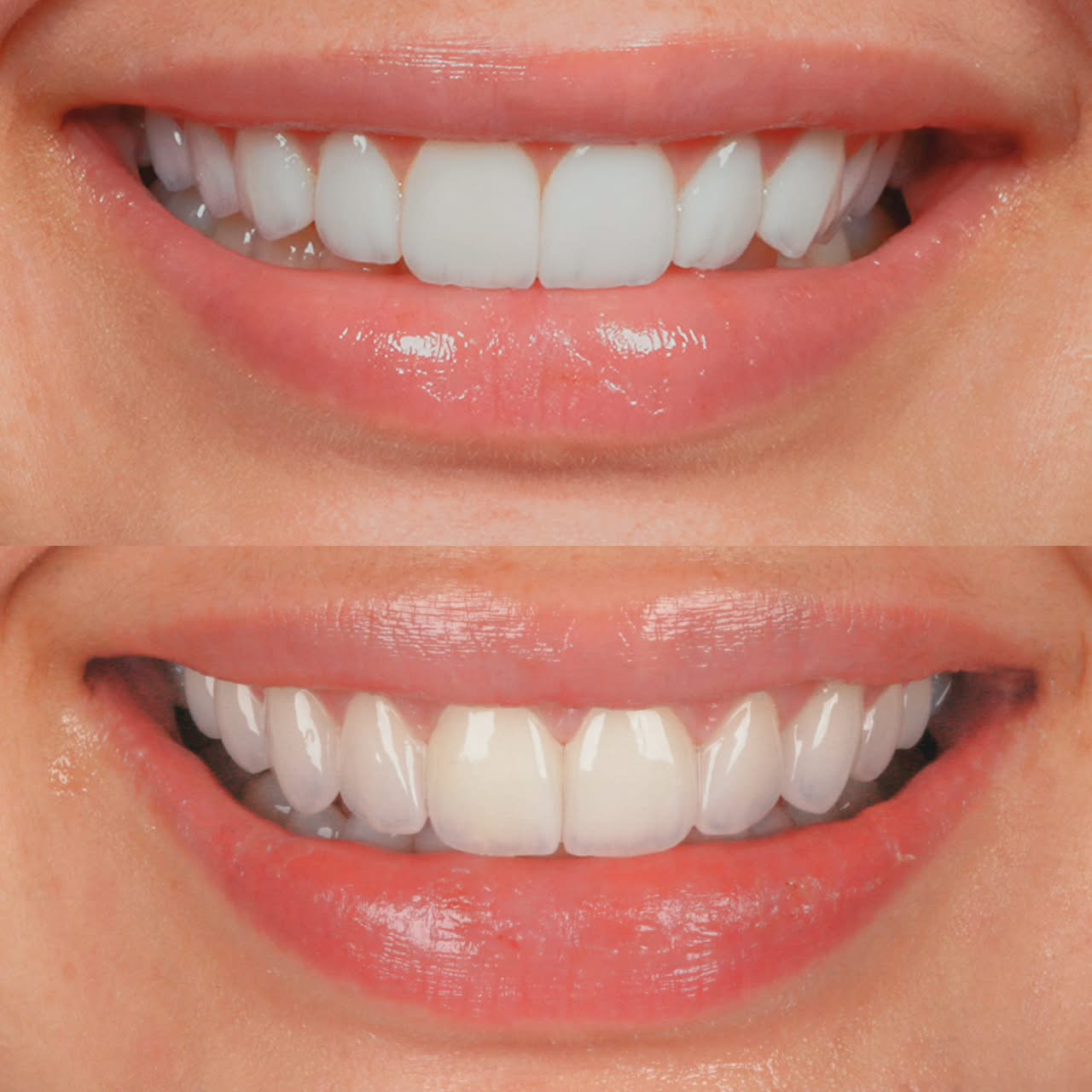 Antes e depois de lentes em paciente da Villodonto