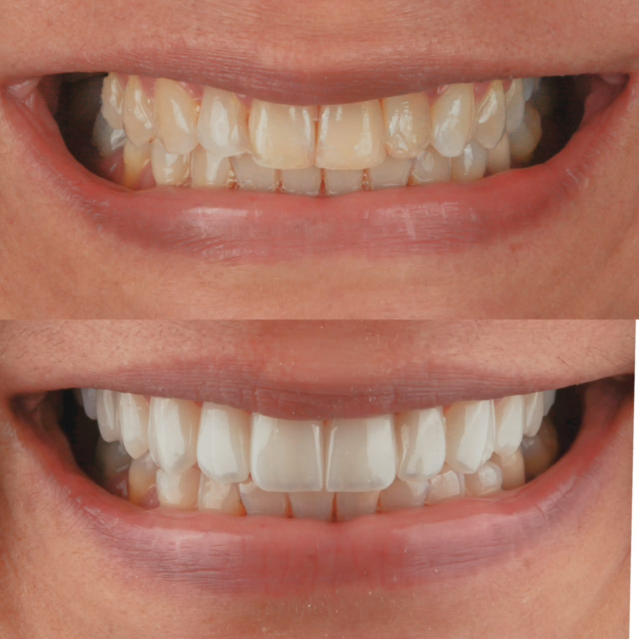 Transformação de sorriso com clareamento e lentes